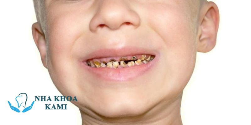 Tại sao trẻ bị sún răng khi mới mọc 