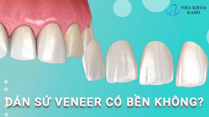 Tuổi thọ của răng Veneer