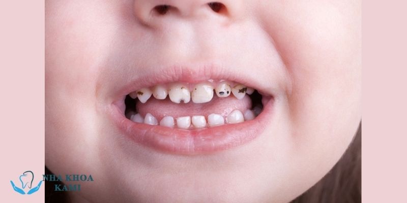 3 loại thuốc trị sâu răng cho bé 