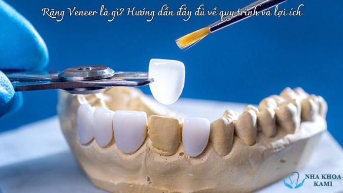 Răng Veneer là gì? Hướng dẫn đầy đủ về quy trình và lợi ích