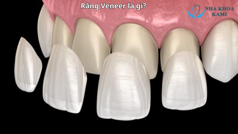 Răng Veneer là gì? 